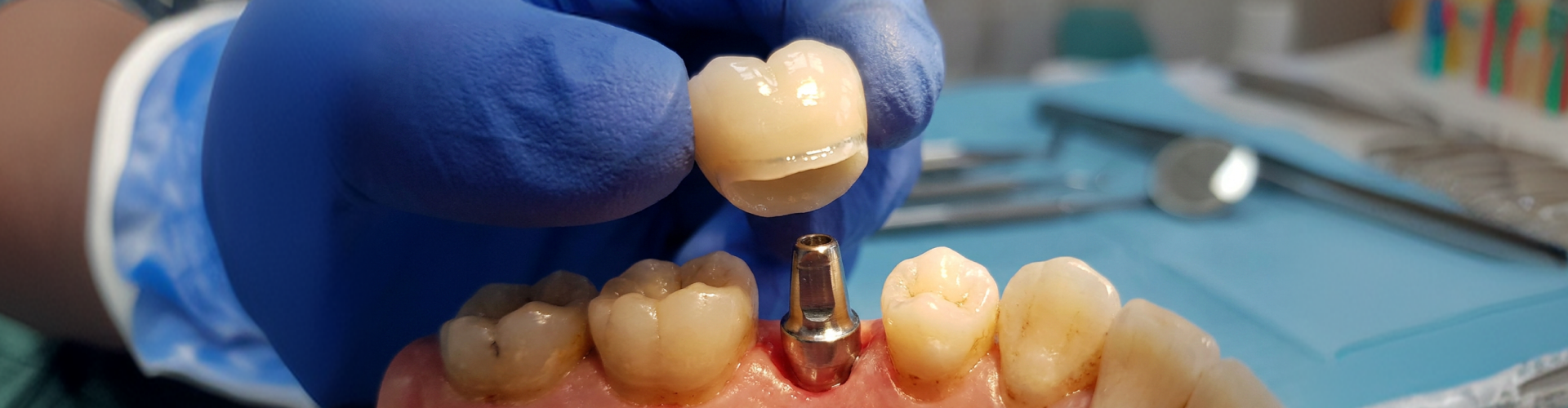 Dental crown being placed onto a dental implant abutment between two natural teeth.